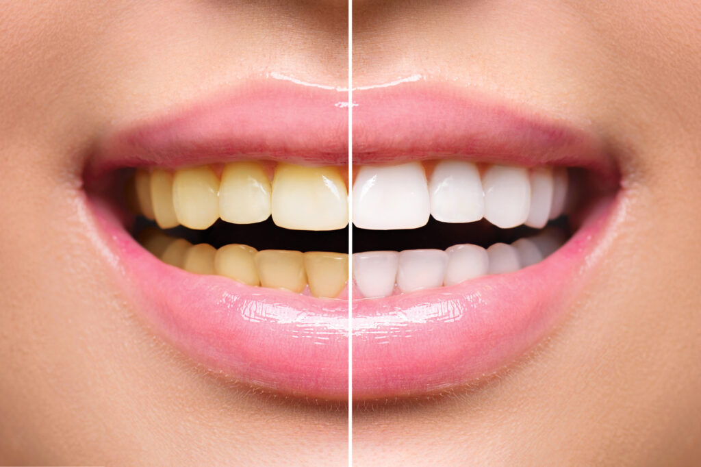 teeth whitening myths busted