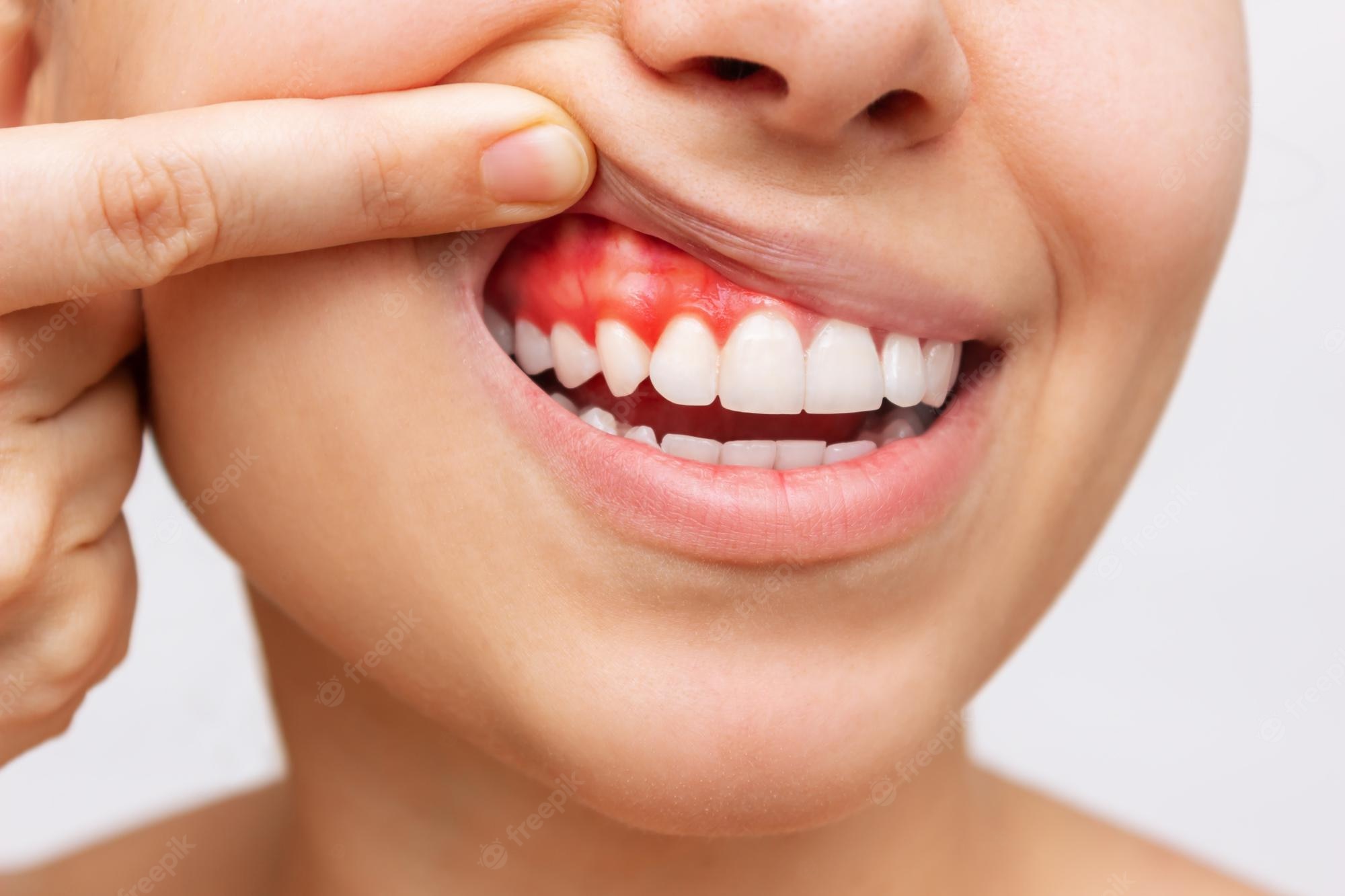Bleeding teeth can be a sign of vitamin C deficiency, correct it with these foods.