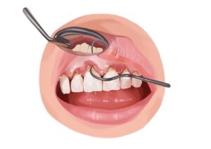 bone loss in teeth