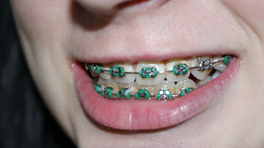 whiten teeth with braces