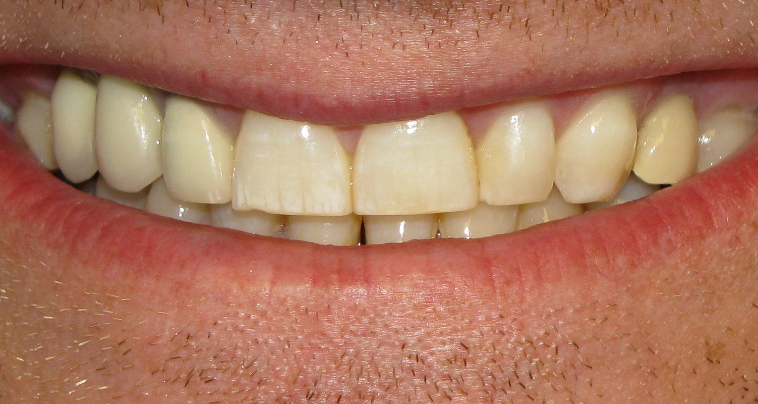 ब्रश करने के बाद भी अगर आपके दांत रहते हैं पीले, तो समझिए इन बीमारियों का… Yellow Teeth after Brushing There can be many reasons for teeth turning yellow and it can also be a sign of diseases.