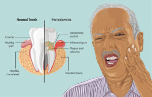 slow down bone loss in teeth