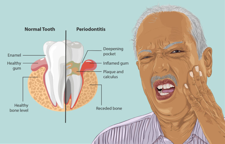 how-to-slow-down-bone-loss-in-teeth-express-dentist