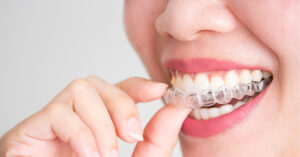 Closeup of a woman's mouth with a clear aligner tray in her hand